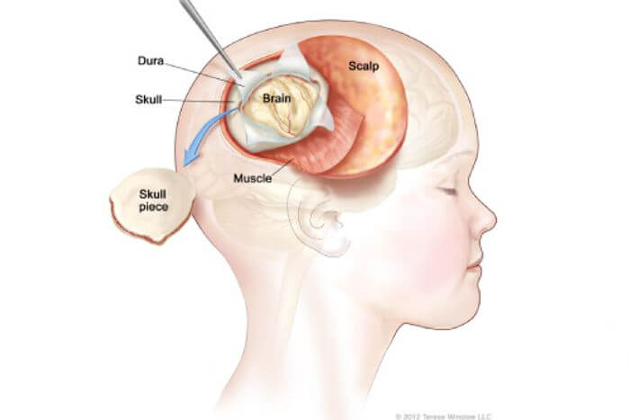 children with craniopharyngioma