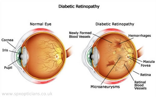 What is Diabetic Retinopathy?