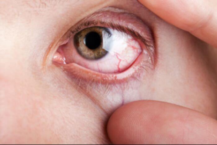 Diabetic retinopathy