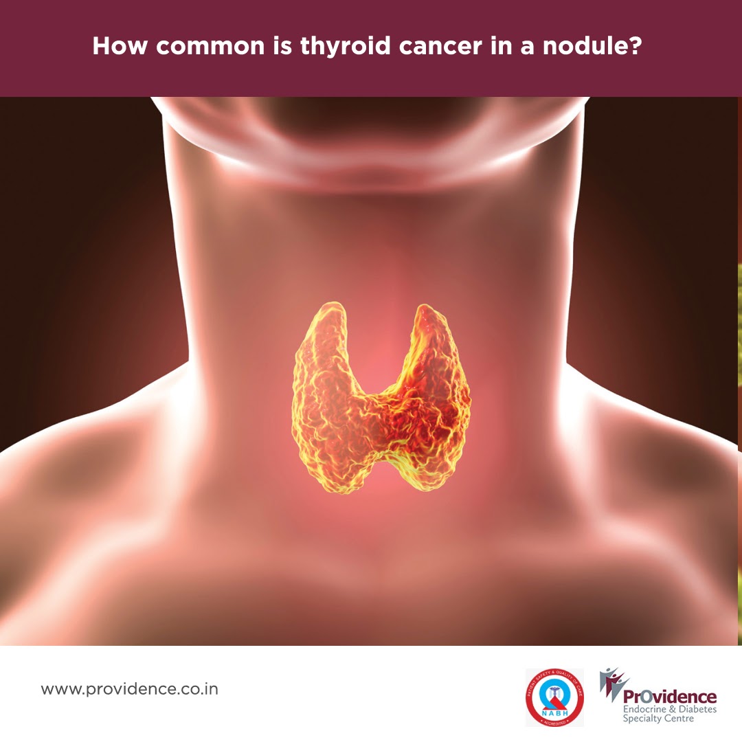 How Common Is Thyroid Cancer In A Nodule Providence Specialty Centre